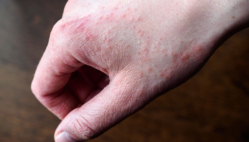 Dermatit (egzama) neden olur Tedavisi var mıdır Dermatit (egzama) neden olur Tedavisi var mıdır