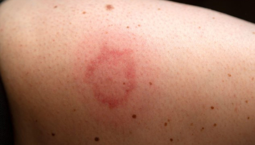 Böcek Isırığı Nasıl Olur Ve Nasıl Anlaşılır Böcek Isırığı Nasıl Geçer Ve Ne İyi Gelir