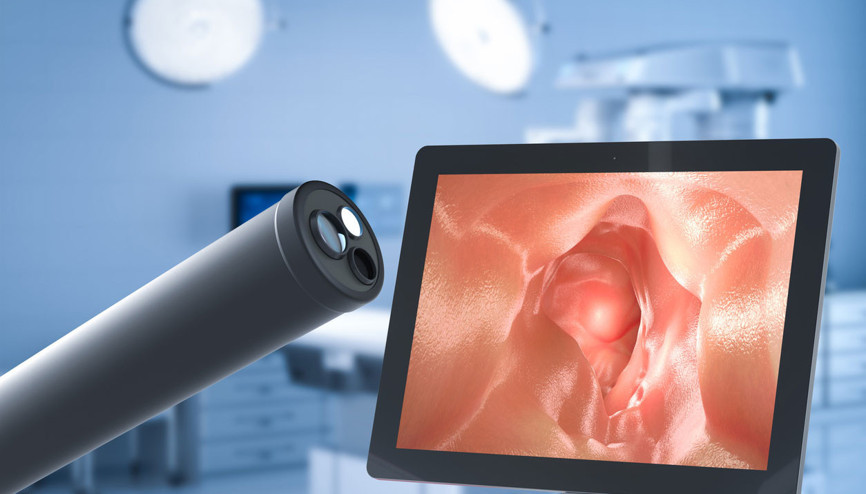 Pandemi, kolon kanserinde erken tanıyı engelliyor