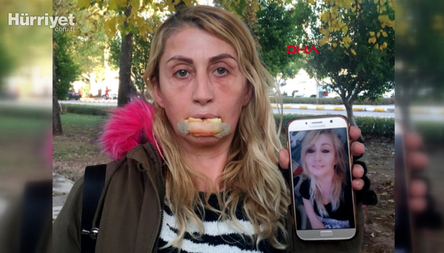 Estetik uğruna dudağı çürüyen Songülün hukuk mücadelesi devam ediyor