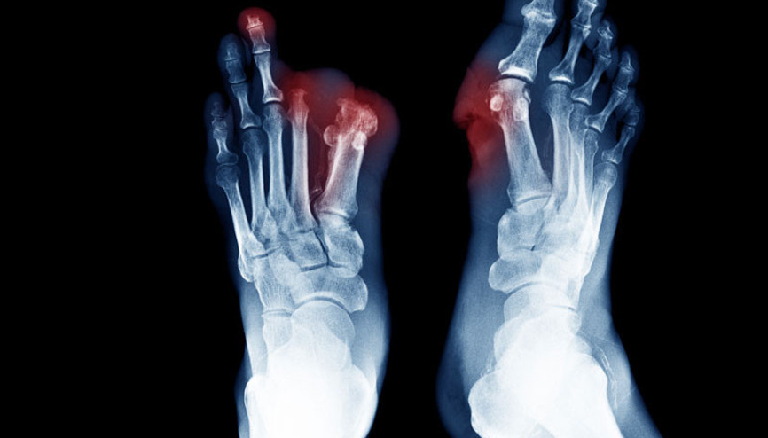 Covid-19 kaynaklı kangren vakalarına dikkat