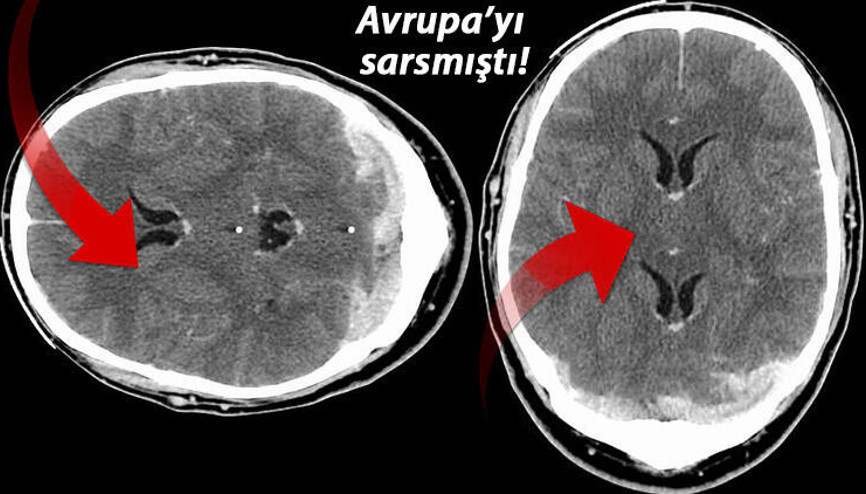 Avrupa İlaç Ajansı AstraZeneca raporunu açıkladı