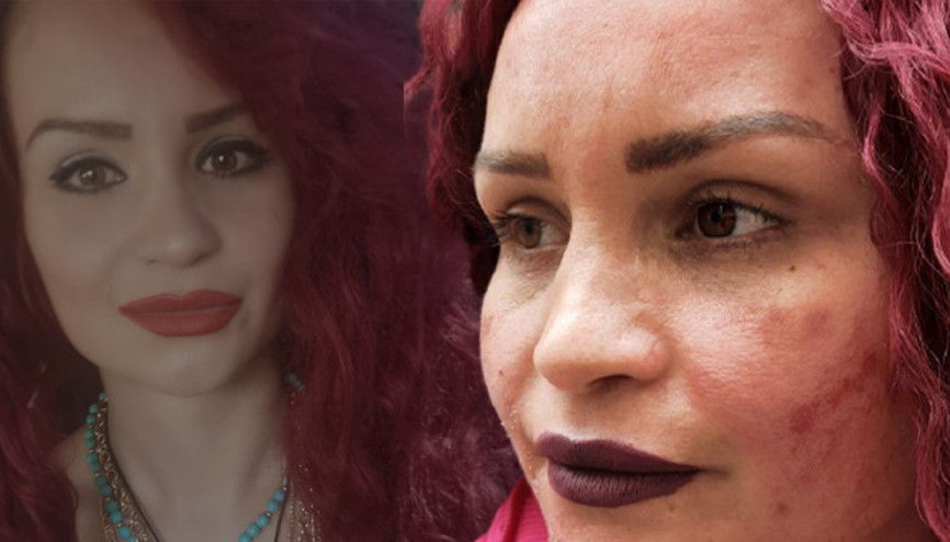 Leke tedavisi için gittiği güzellik merkezinde şoku yaşadı