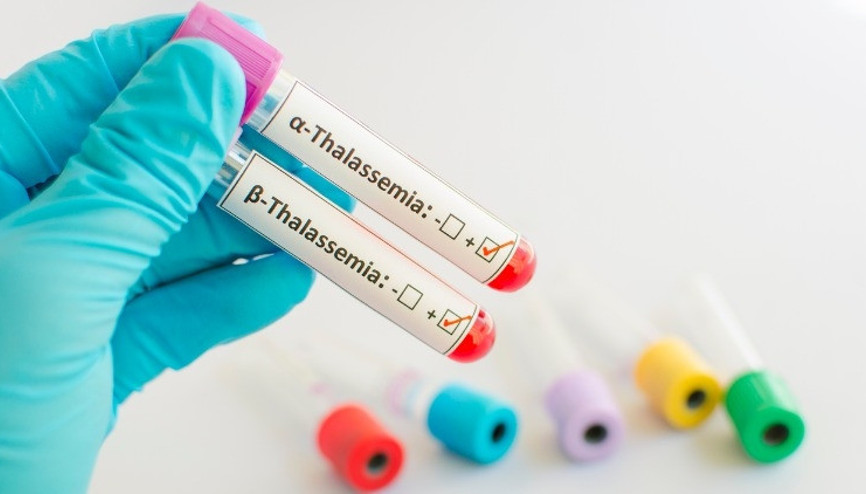 Akdeniz anemisi nedir, nasıl anlaşılır Akdeniz anemisi belirtileri ve tedavisi