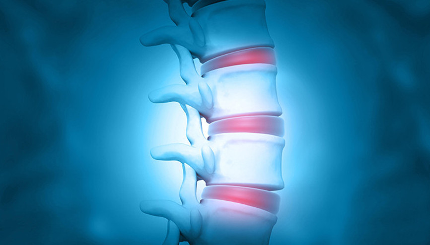 Skolyoz nedir Skolyoz belirtileri ve tedavisi hakkında bilinmesi gerekenler