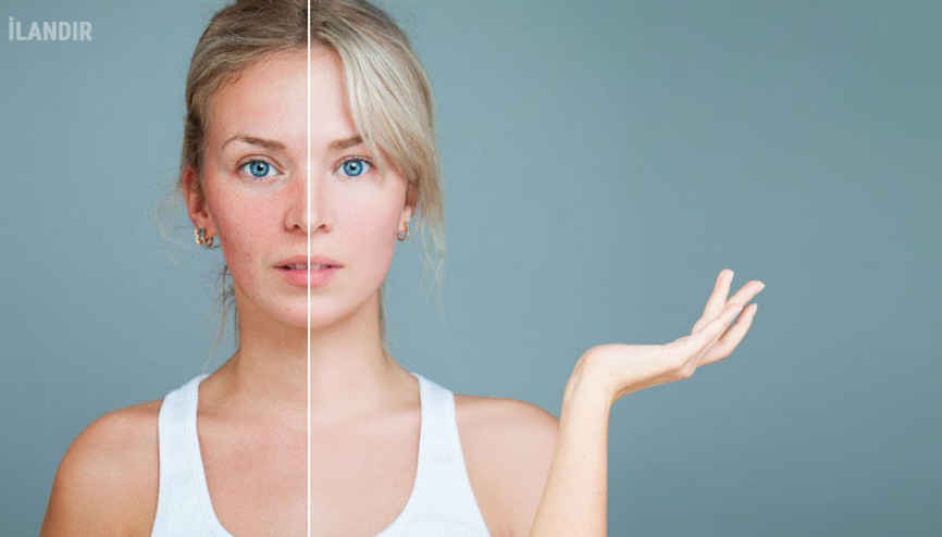 Sivilce tedavisinde dikkat edilecek noktalar Sivilce tedavisinde dikkat edilecek noktalar