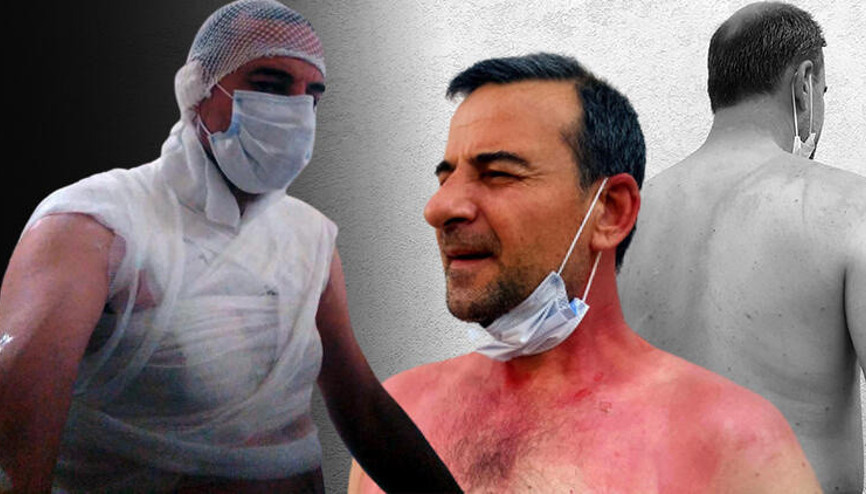 Sigara dumanı nedeniyle tartıştığı komşusunun üzerine kaynar su döktü