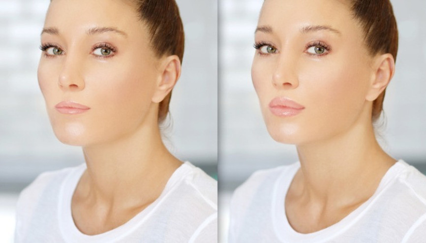 Dudak dolgusunun avantajları Dudak dolgusunun avantajları