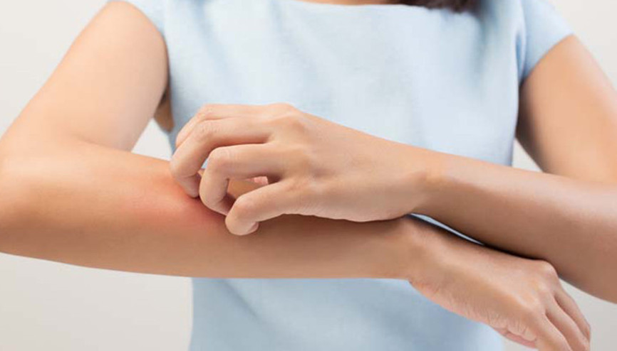 Egzama belirtileri nelerdir