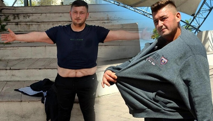 Sevgilisinin ailesi beğenmeyince 212 kilo veren akın, yağlarından kurtulmak istiyor