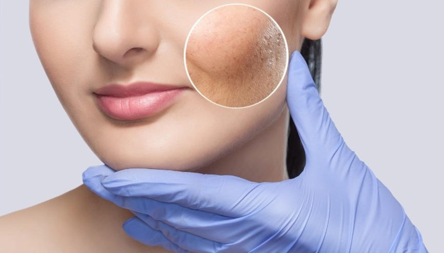 Thulium cilt yenileme lazeri nedir