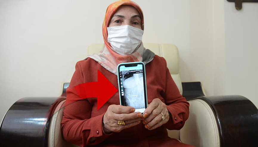 Karnında unutulan makasla 2 ay yaşadı Karnında unutulan makasla 2 ay yaşadı