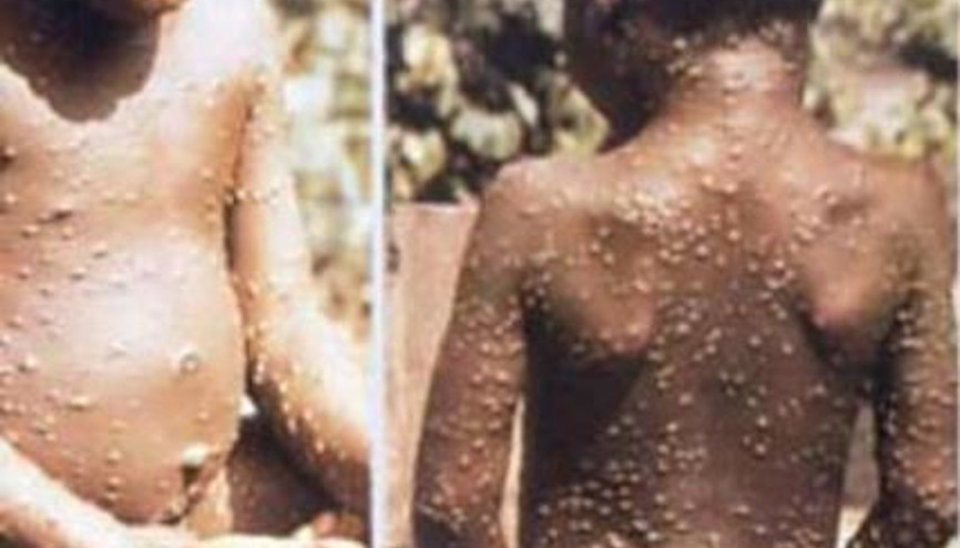 Monkeypox (Maymun çiçeği) virüsü nedir, belirtileri nelerdir.. Salgın yayılmaya devam ediyor..