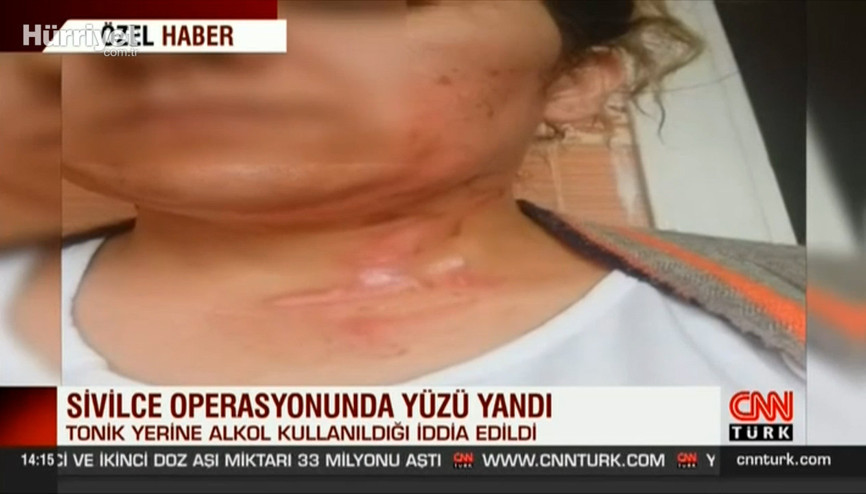 Sivilce operasyonunda yüzü yandı