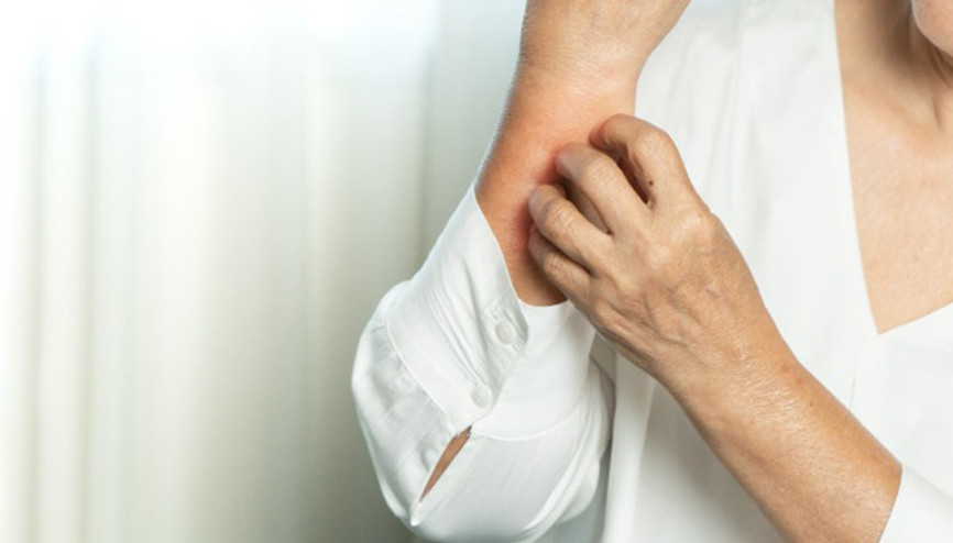 Isı Ürtikeri (Kurdeşen) Belirtileri Nelerdir, Nasıl Geçer Isı Ürtikerini Önlemeye Yardımcı Olabilecek Önlemler