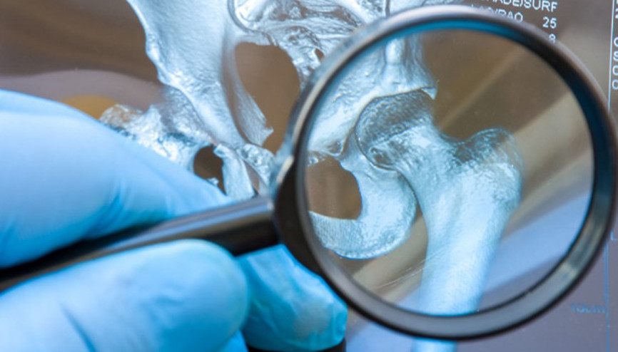 Kemik erimesi (osteoporoz) nedir, neden olur Kemik erimesi belirtileri ve tedavisi