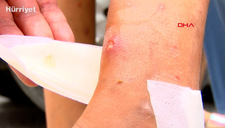 Avcılarda sivrisinek kabusu; çocuklarda yaralar oluştu