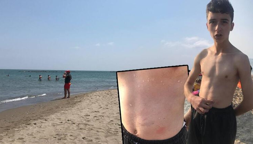 Sakarya Karasu’da kaşınmanın nedeni deniz anası