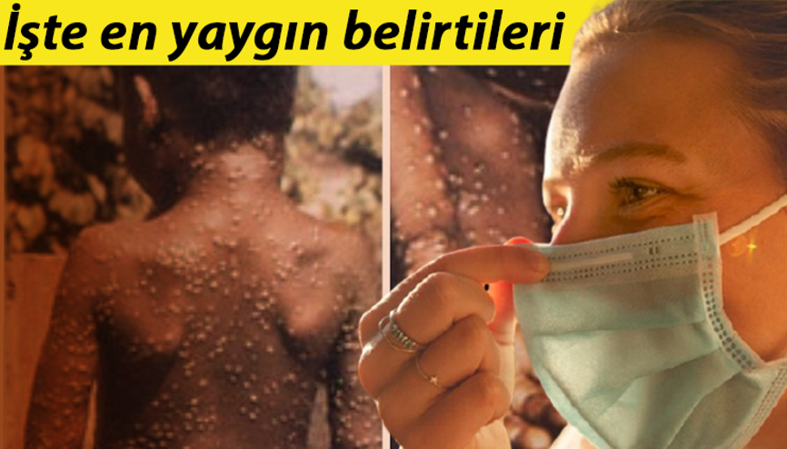 Son dakika... Dünyayı tedirgin eden gelişme: ABDde Monkeypox alarmı