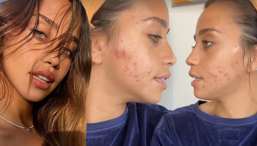 Zeynep Alkan: Öz güvenim sıfır, dışarı bile çıkmak istemiyorum