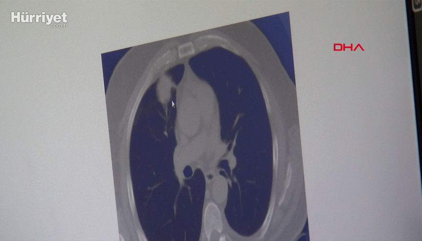 Dünya tıp literatüründe bir ilk: Covid-19, akciğer kanserini taklit etti