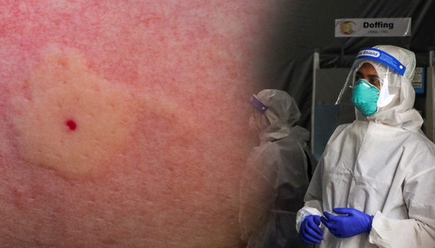 Koronavirüsü atlatanlarda saç boyasına karşı alerjik reaksiyon