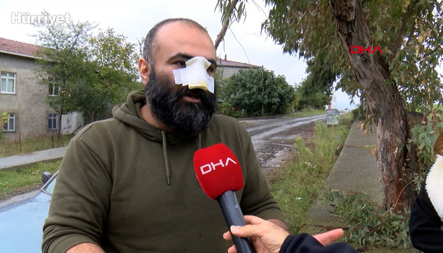 Tasmasız dolaştırılan Pitbull, iş insanının burnunu kopardı