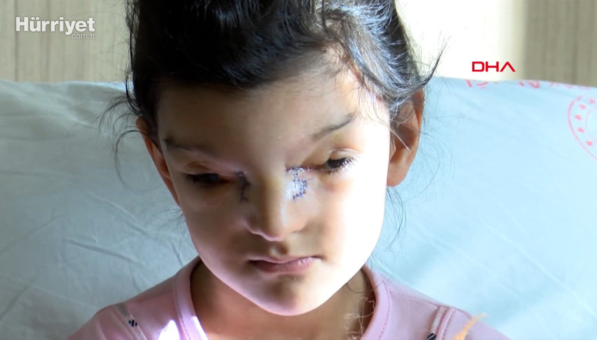 Ayşenurun gözleri arasındaki mesafe 3 santime düşürüldü