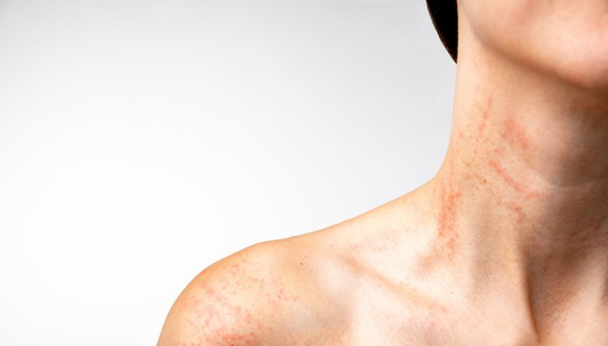 Ürtiker (Kurdeşen) nedir, neden olur Ürtiker belirtileri ve tedavi yöntemleri