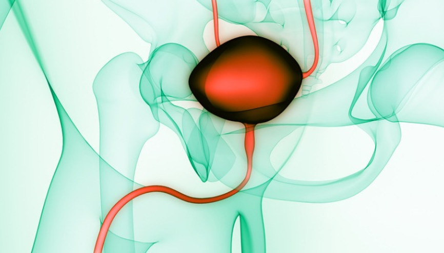 Mesane kanseri nedir