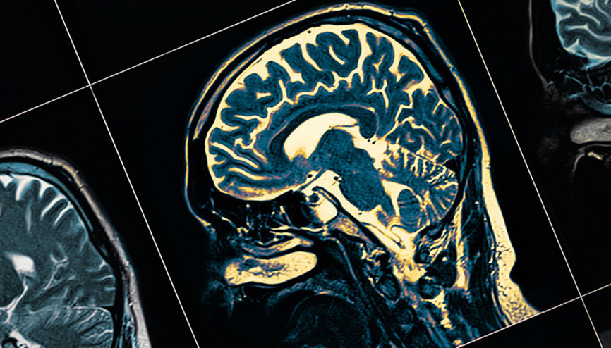 Hasta ve hasta yakını milyonlarca kişiyi ilgilendiriyor... Aşı Alzheimera umut olur mu Hasta ve hasta yakını milyonlarca kişiyi ilgilendiriyor... Aşı Alzheimera umut olur mu