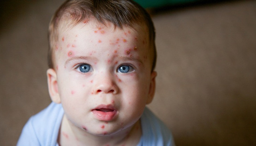 Su çiçeği nasıl olur, belirtileri nelerdir İşte su çiçeği tedavisi
