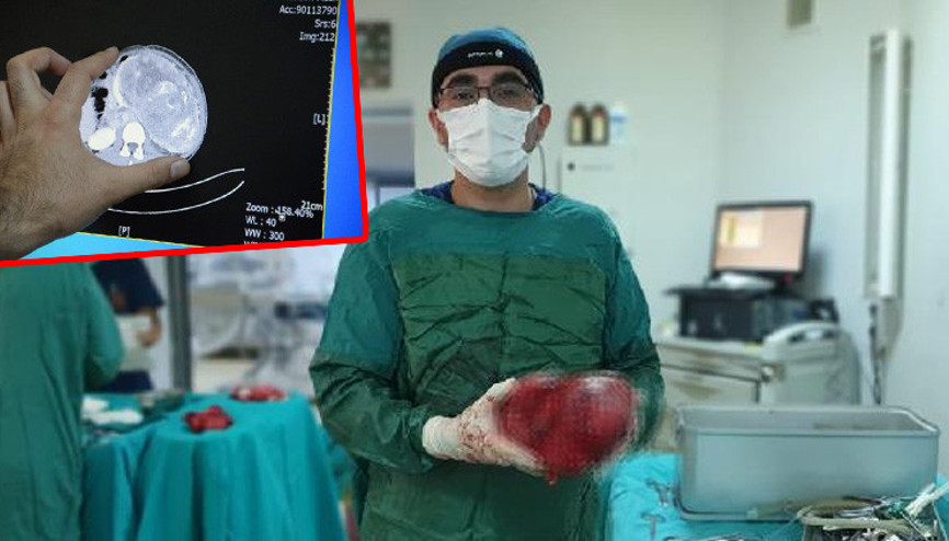 Ağrı şikayetiyle gitti gerçek çok farklı çıktı: 5,5 kiloluk böbrek tümörü çıkarıldı