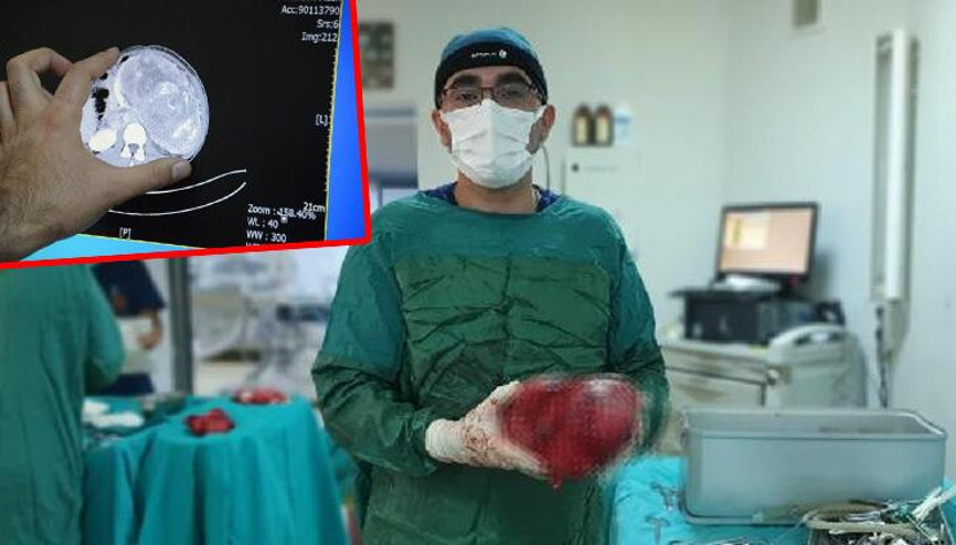Karnından 5,5 kiloluk böbrek tümörü çıkarıldı