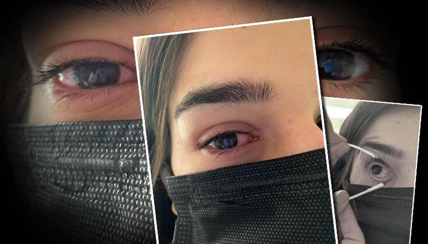 Şimdi de gözlerde virüs salgını; uzmanlar adenovirüse karşı uyarıyor