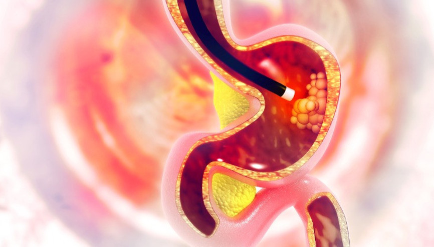 Endoskopi nedir, nasıl yapılır Endoskopi öncesi hazırlık ve endoskopi sonrası beslenme bilgileri