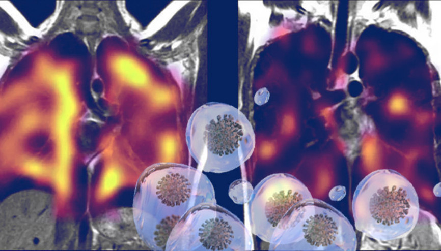 Akciğerlerde gizli hasar... Uzun Kovidin sırrı çözülüyor Akciğerlerde gizli hasar... Uzun Kovidin sırrı çözülüyor