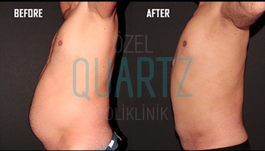 Dr. Leyla Arvas liposuction hakkında tüm merak edilenleri cevaplıyor… Dr. Leyla Arvas liposuction hakkında tüm merak edilenleri cevaplıyor…