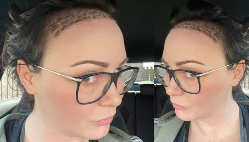 Kendimden nefret eder hale gelmiştim: Ünlü yıldız sekiz saatlik operasyonla saç ektirdi