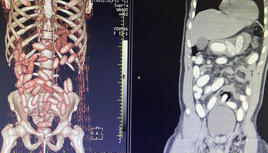 İstanbul Havalimanında 7 yolcunun midesinden 11 kilo kokain çıktı