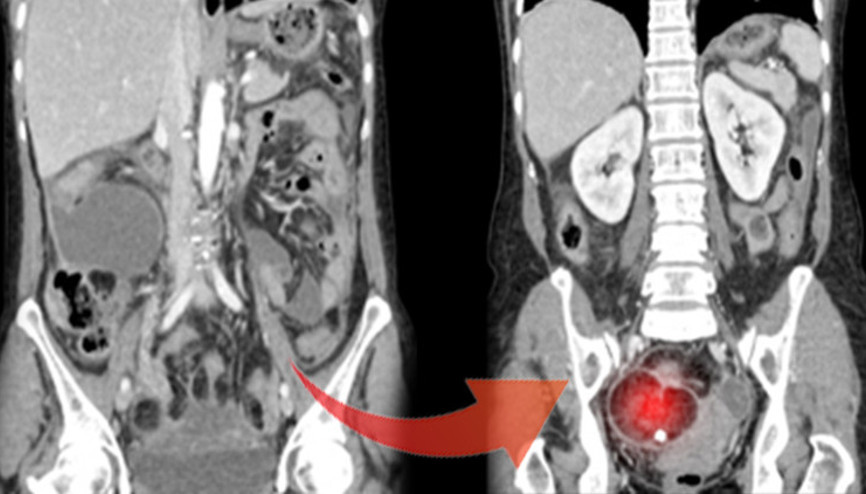 9 kiloluk tümörü görenler şaşkına döndü Özellikle genç kadınlarda çok yaygın...