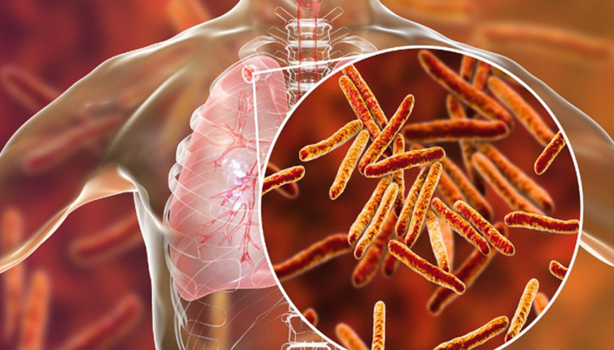 Tüberküloz nedir Tüberküloz (Verem) belirtileri ve tedavisi