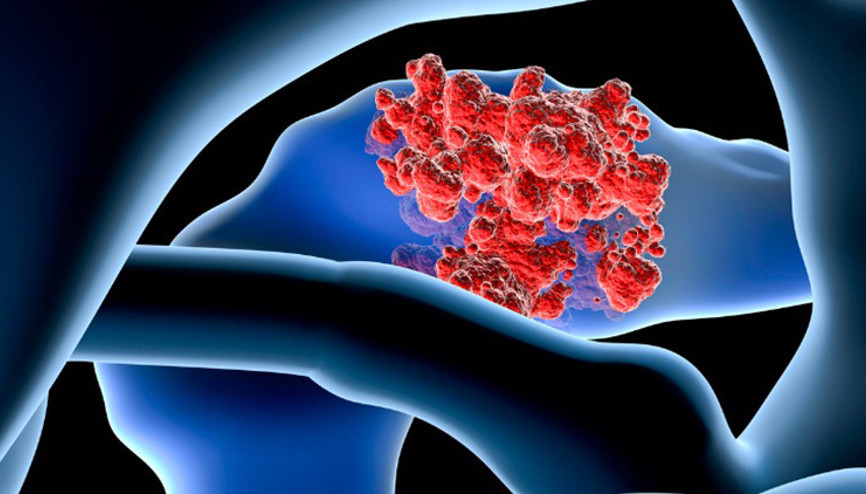 Tedavide yeni gelişmeler umut veriyor Pankreas kanseri tedavisinde merak edilen 10 soru 10 yanıt