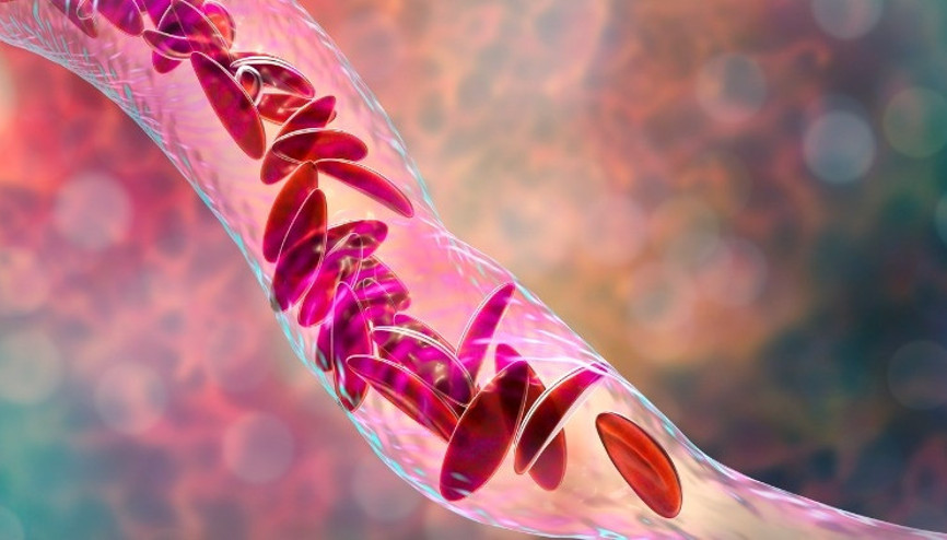 Kök hücre nakli ile tedavi edilebiliyor Talasemi hakkında en çok merak edilen 7 soru