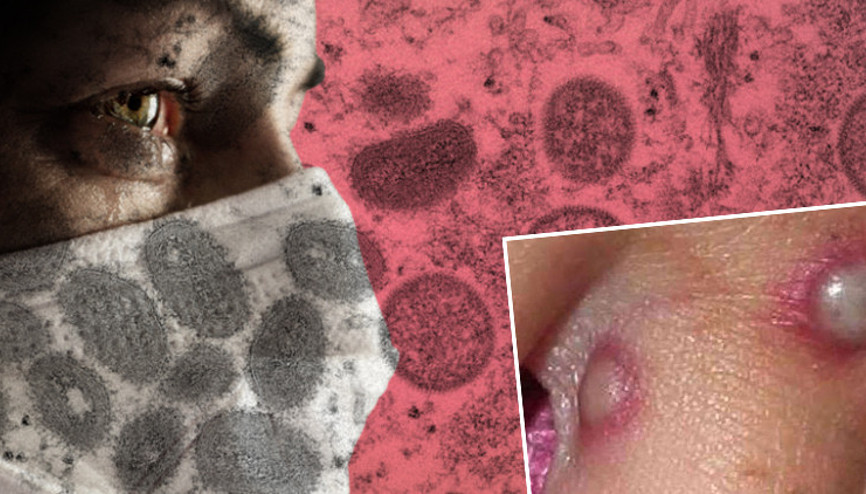 Son dakika: Maymun çiçeği virüsü 4 ülkeye daha sıçradı... CDCden flaş açıklama geldi