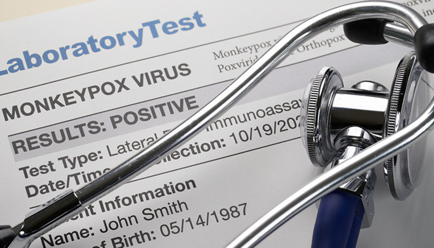 Maymun çiçeği virüsünde çarpıcı bulgular...76 gün boyunca vücuttan atılmadı