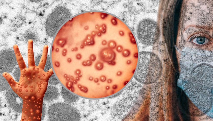 ABDde Maymun çiçeği virüsü alarmı... CDCden flaş açıklama geldi