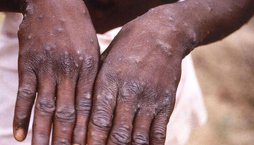 Maymun çiçeği virüsü belirtileri nedir Maymun çiçeği virüsü Türkiye’de var mı Bakan Koca’dan açıklama