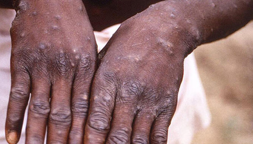 Brezilyada ilk maymun çiçeği vakası