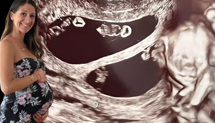 Ultrasona giren anne adayı hayatının şokunu yaşadı 70 milyonda bir görülüyor...